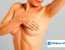 shramy posle mammoplastiki 65x50 - Как исправить шрам после увеличения груди